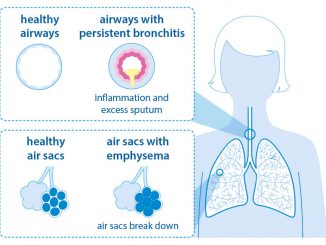 COPD bronchitis emphysema graphic