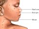 Chickenpox ; Signs Symptoms, Pathogenesis, Prevention, treatment