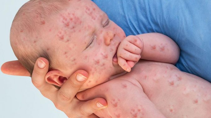 Measles Transmission, Sign and Symptoms and Prevention