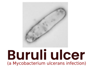 Buruli ulcer (a Mycobacterium ulcerans infection)